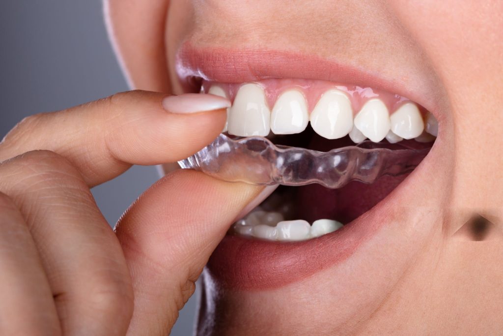 Aligner dentar