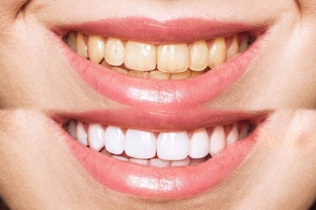 Fatete dentare din portelan