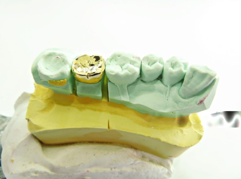 coroana dentara aur-platina