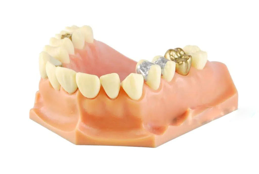 Coroane ceramice aur-platina