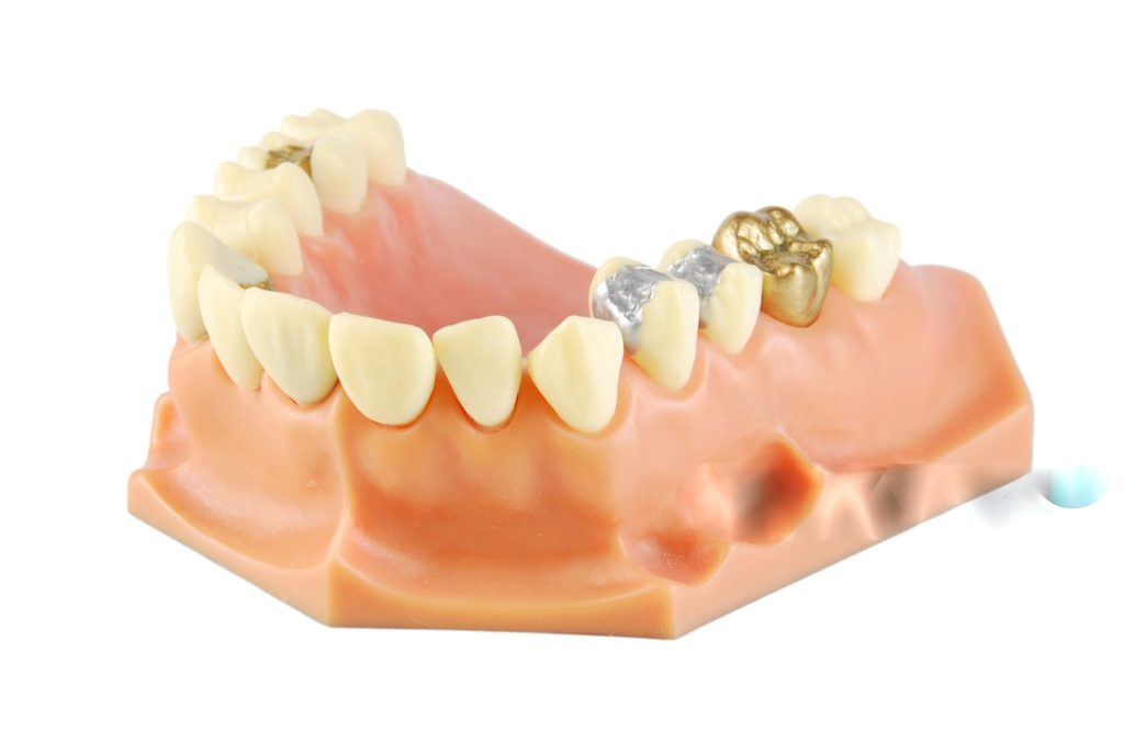 coroane dentare aur-platina