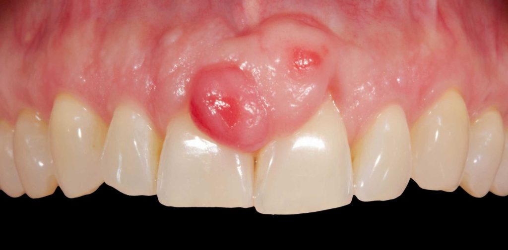 epulis gingival simptome