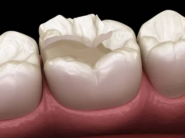 Incrustatia ceramica, alternativa la plomba clasica