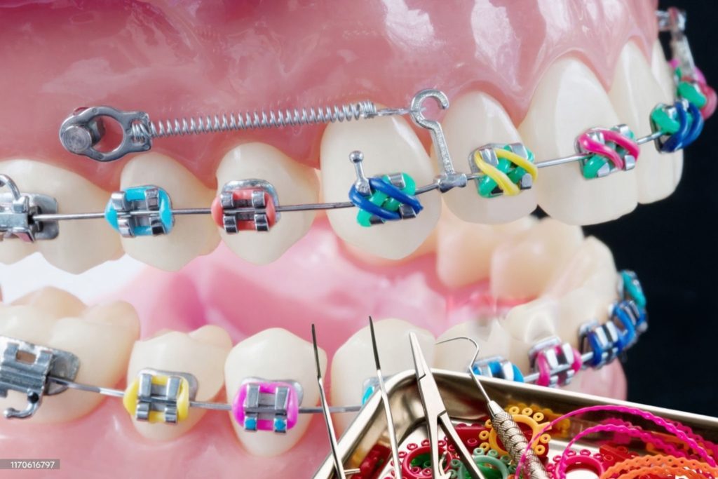 mini implant ortodontic