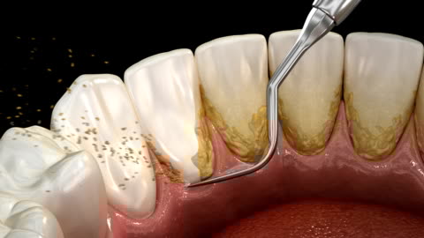 placa bacteriana