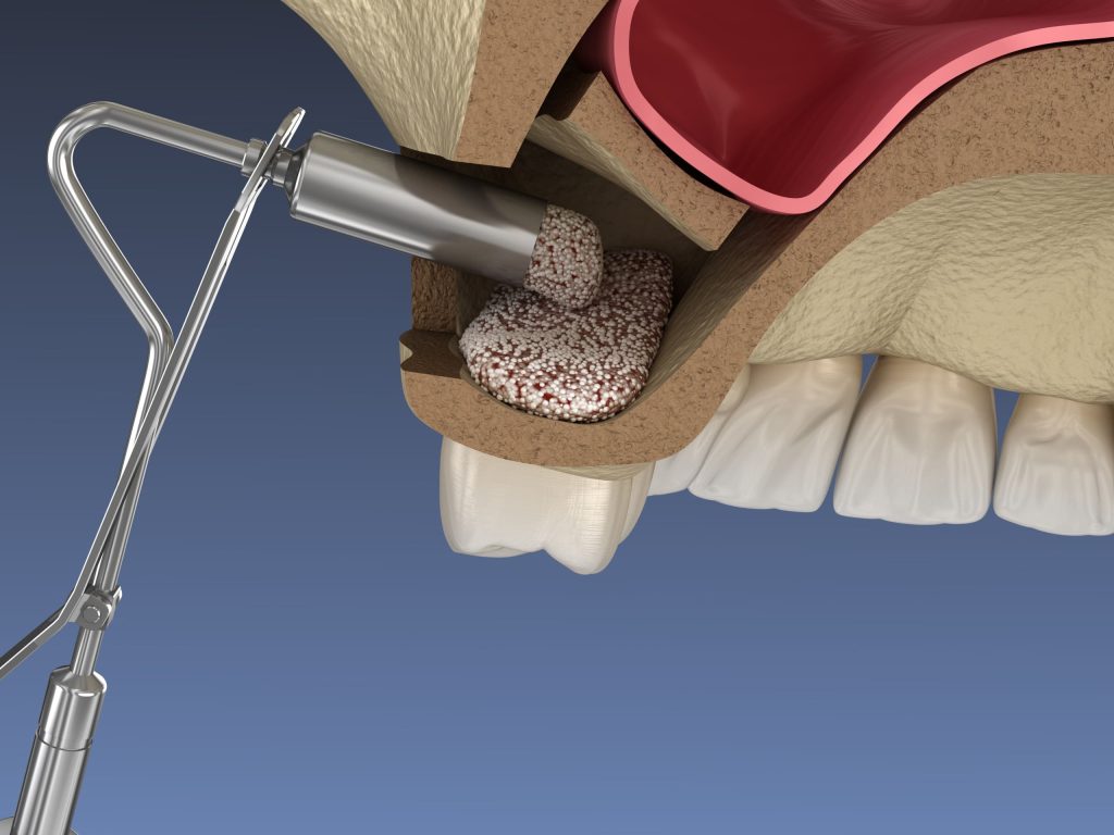 sinus lifting