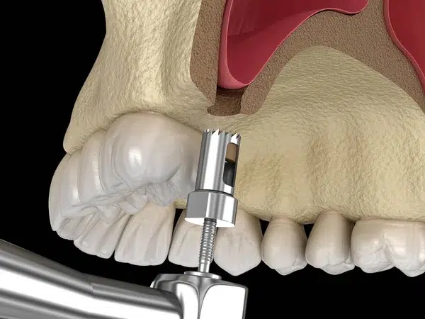 sinus lifting Bucuresti