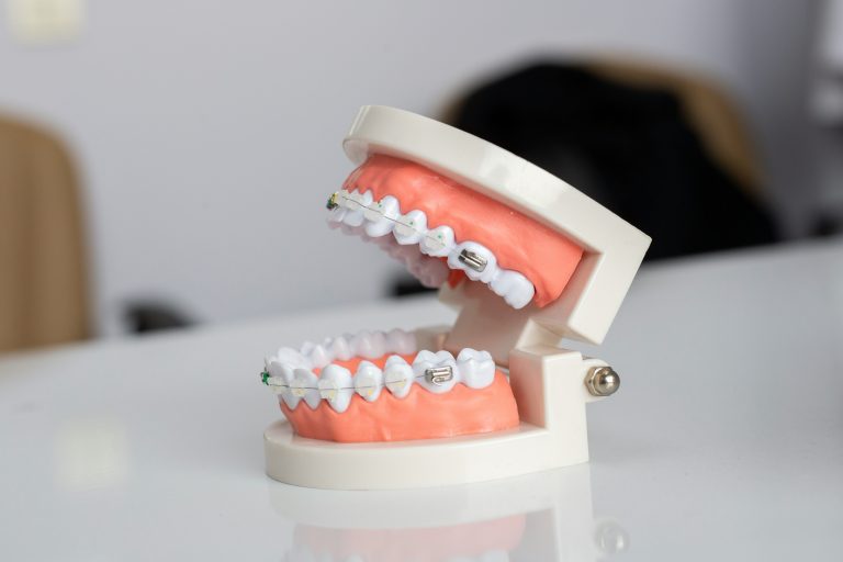 aparat dentar, utilitatea unui aparat dentar