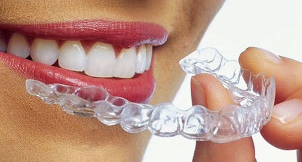 alternativă invizibilă a aparatelor dentare cu brackeți