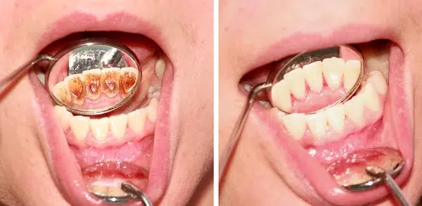 sensibilitatea dentară