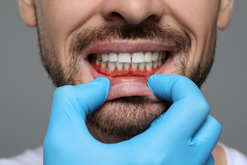grefe gingivale