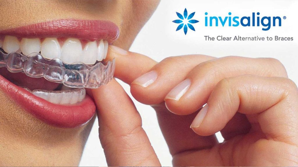 aparat dentar bucuresti invisalign