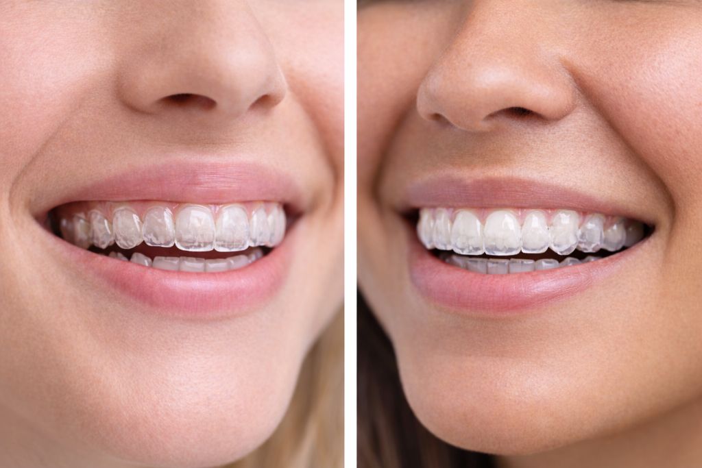 diferenta dintre spark si invisalign
