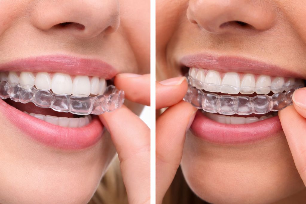 spark vs invisalign