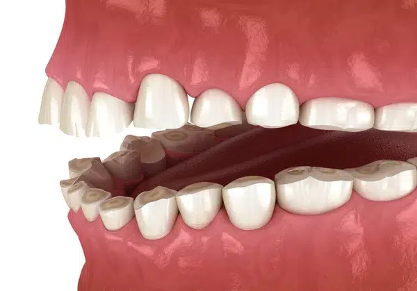 bruxism