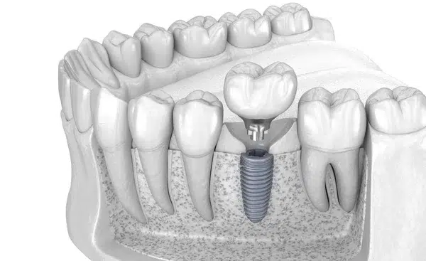 Implantul dentar