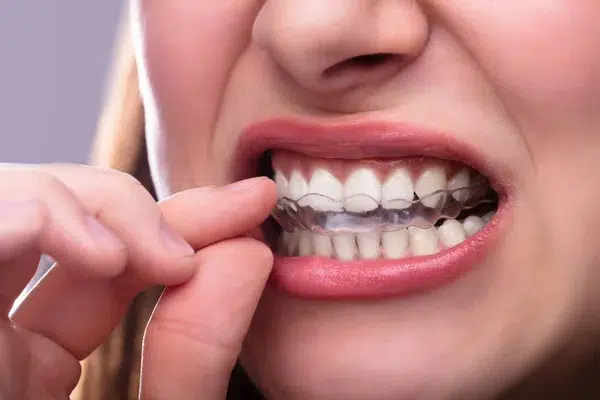 aparat dentar Clear Aligner, ortodonția