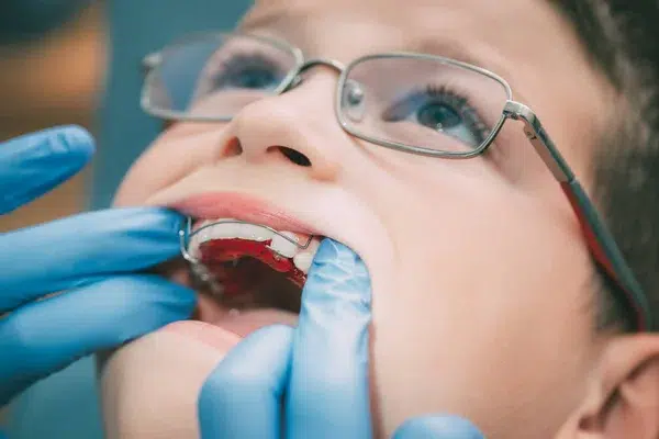 aparat dentar mobil