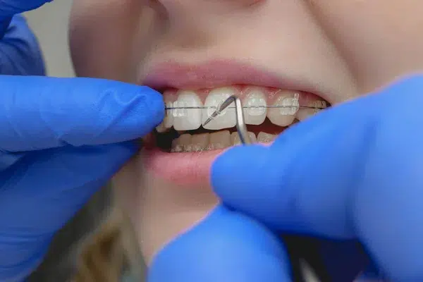 aparat dentar safir
