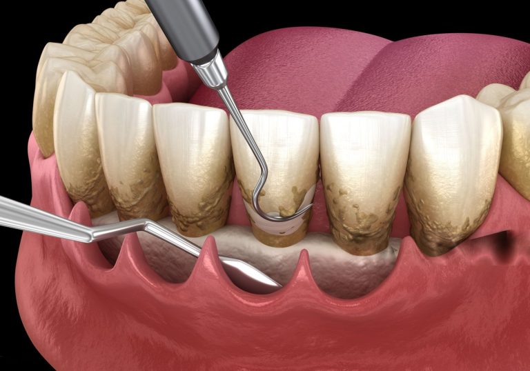 Chiuretaj subgingival, pret Chiuretaj subgingival