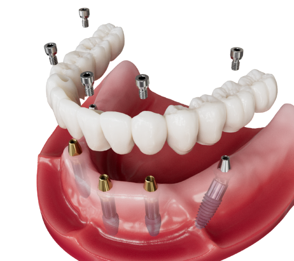 implant dentar Megagen AnyRidge