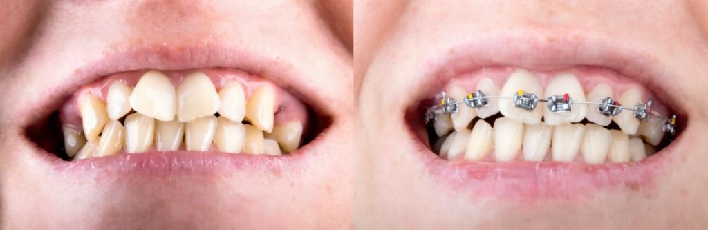 durata tratamentului ortodontic