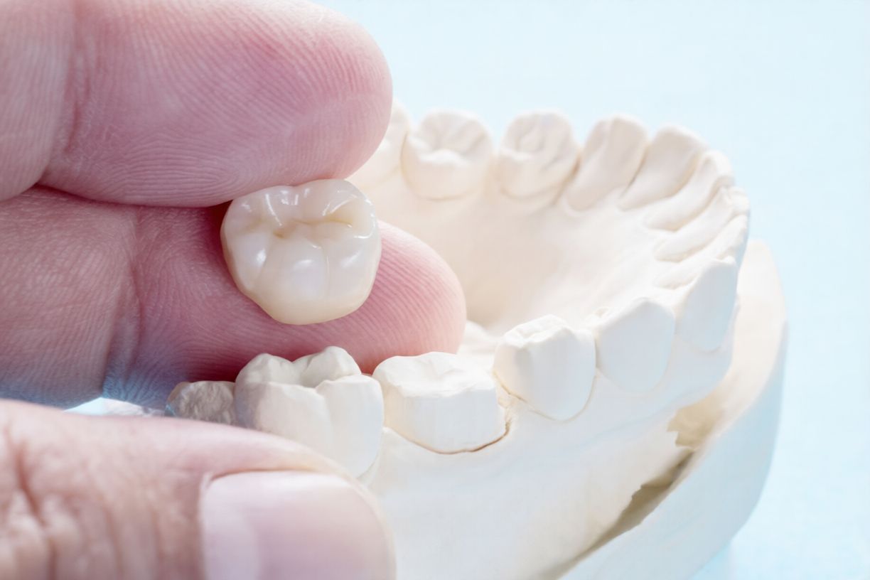 Ce este o coroană dentară
