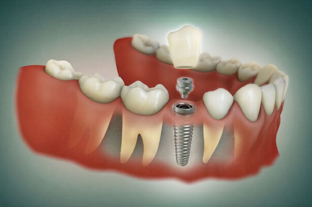 implant dentar premium