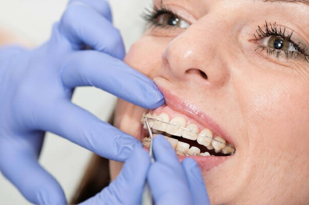 aparat dentar cu safir