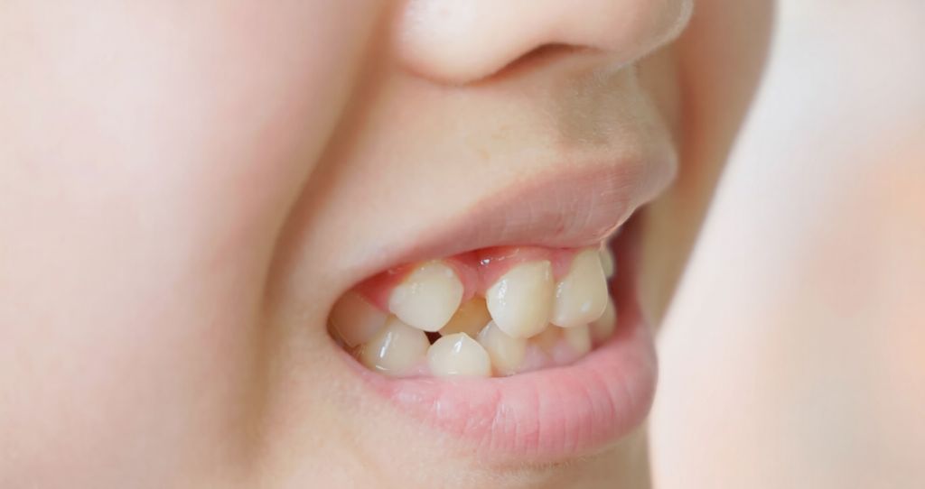 recomandare aparat dentar mobil copii