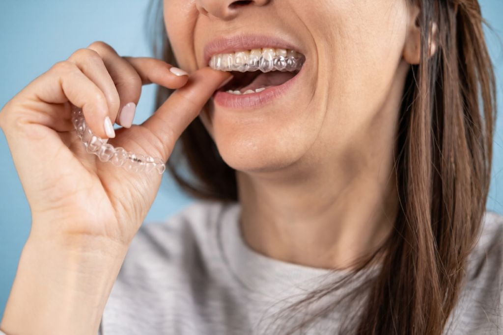 tratament cu aparat dentar invisalign
