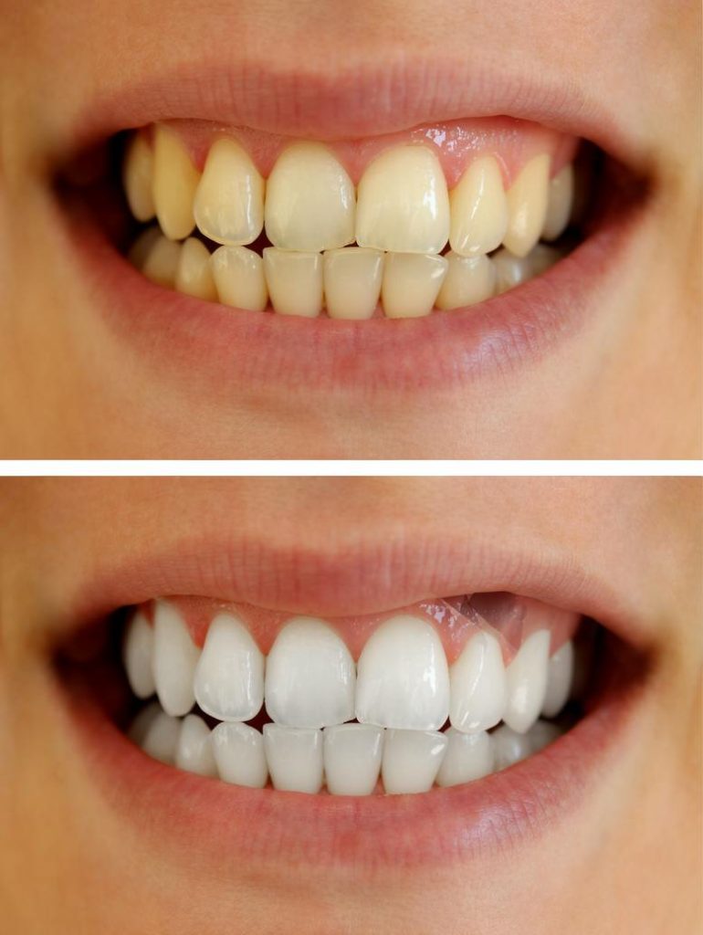 Când sunt recomandate fațetele dentare