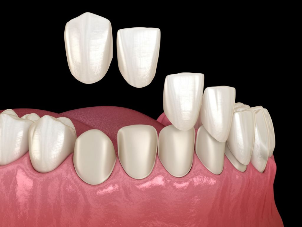 cum se aplica fatetele dentare