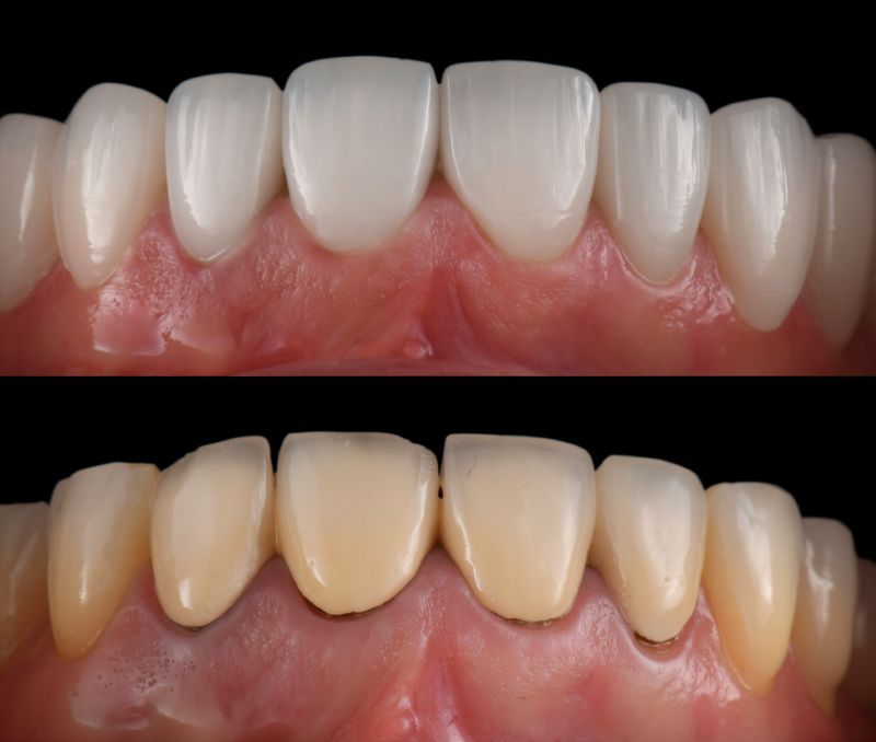 avantaje fateta dentara