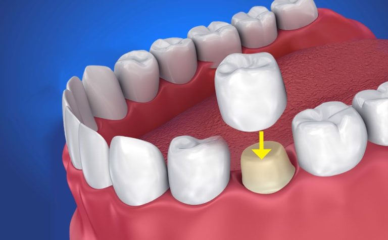 coroană dentară