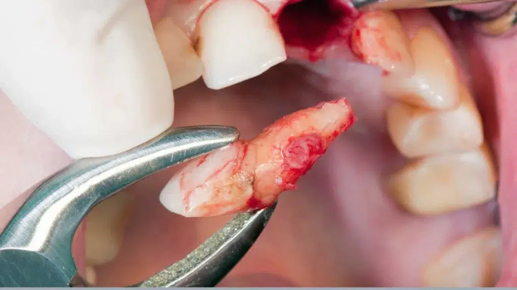 Alveolita