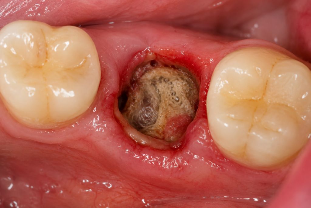 Alveolita